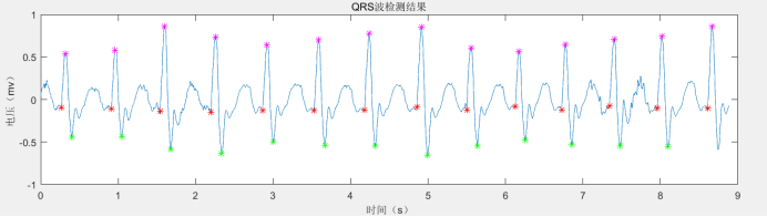 Matlab心电信号QRS波检测