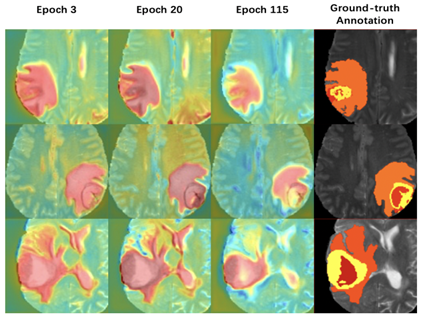 [深度学习论文笔记]A Two-Stage Cascade Model for MRI Brain Tumor Segmentation