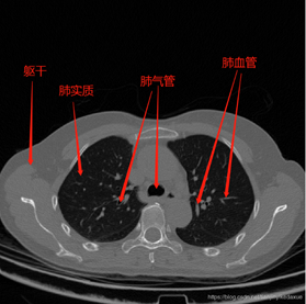 肺部CT图像