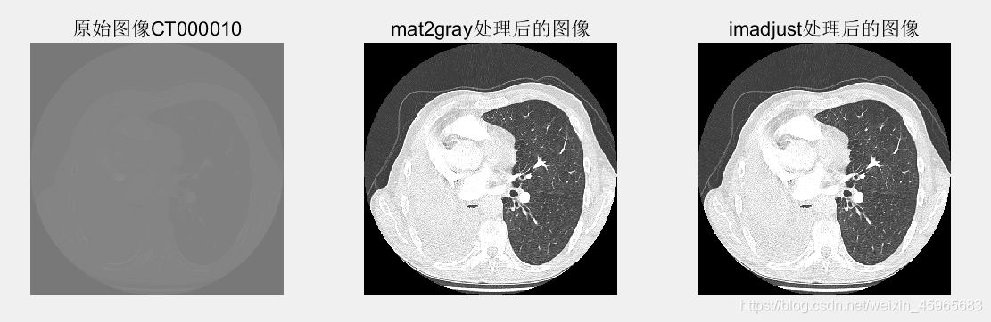 MATLAB学习之图像增强、线性运算、非线性运算、CT图像的开窗显示_matlab图像开窗变换-CSDN博客
