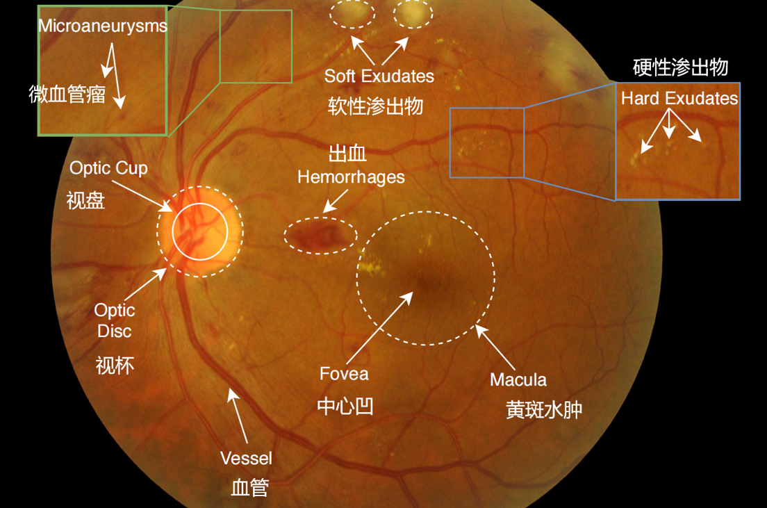 论文笔记applicationsofdeeplearninginfundusimagesareview1