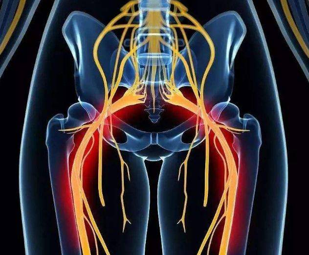 坐骨神经痛按症状分类