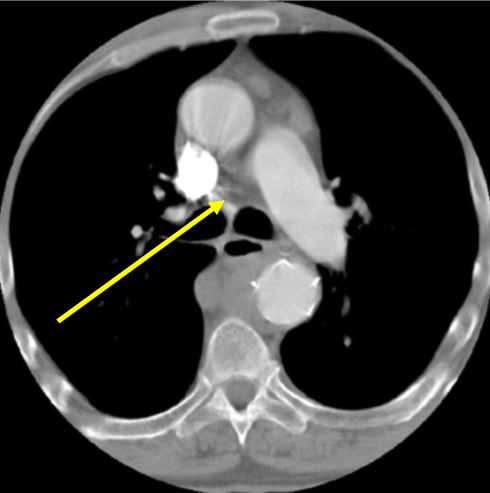 ct图像重建中的伪影