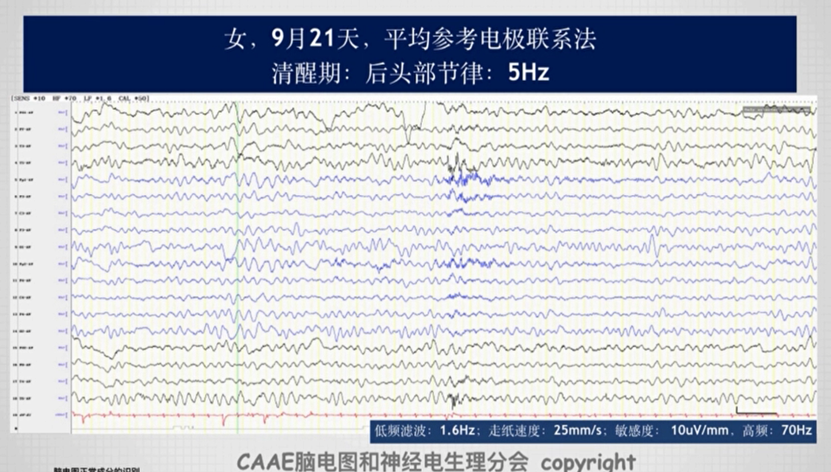 第二课：脑电图一般判读原则脑电图双导针锋相对 Csdn博客