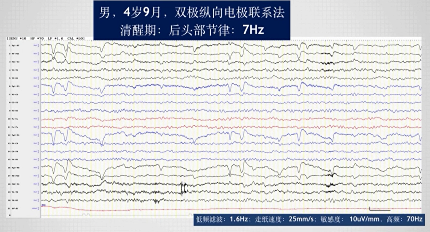 脑电图各种波形及读法图片