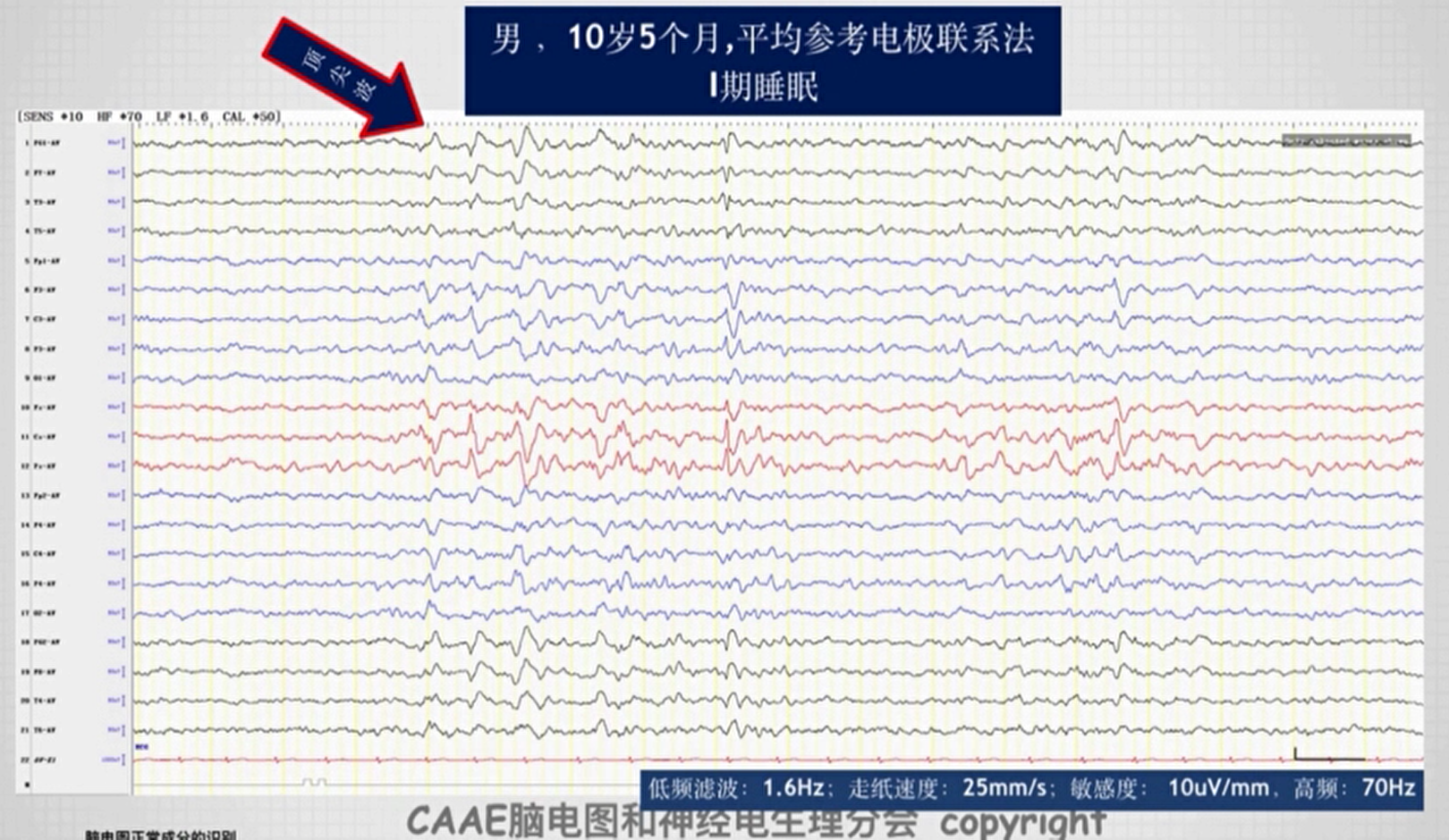 儿童脑电图正常值图片