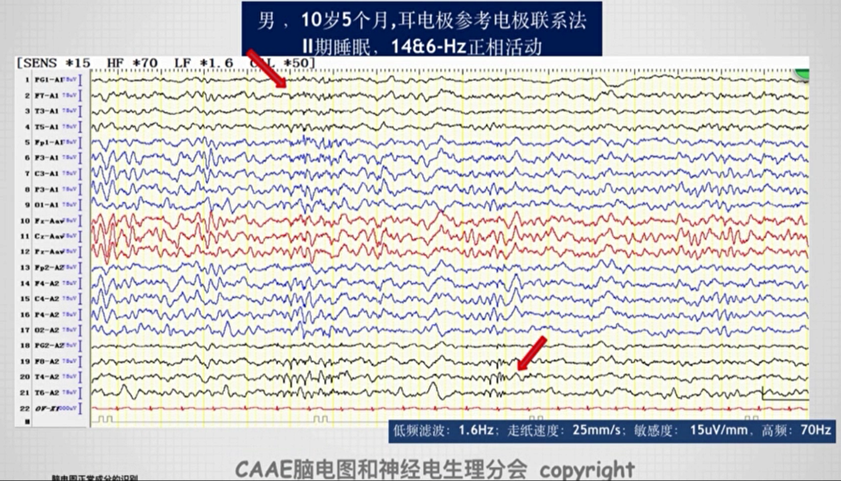 出现于睡眠期的一种脑电图变异,14&6hz的正相脑电图活动,图中双侧颞区
