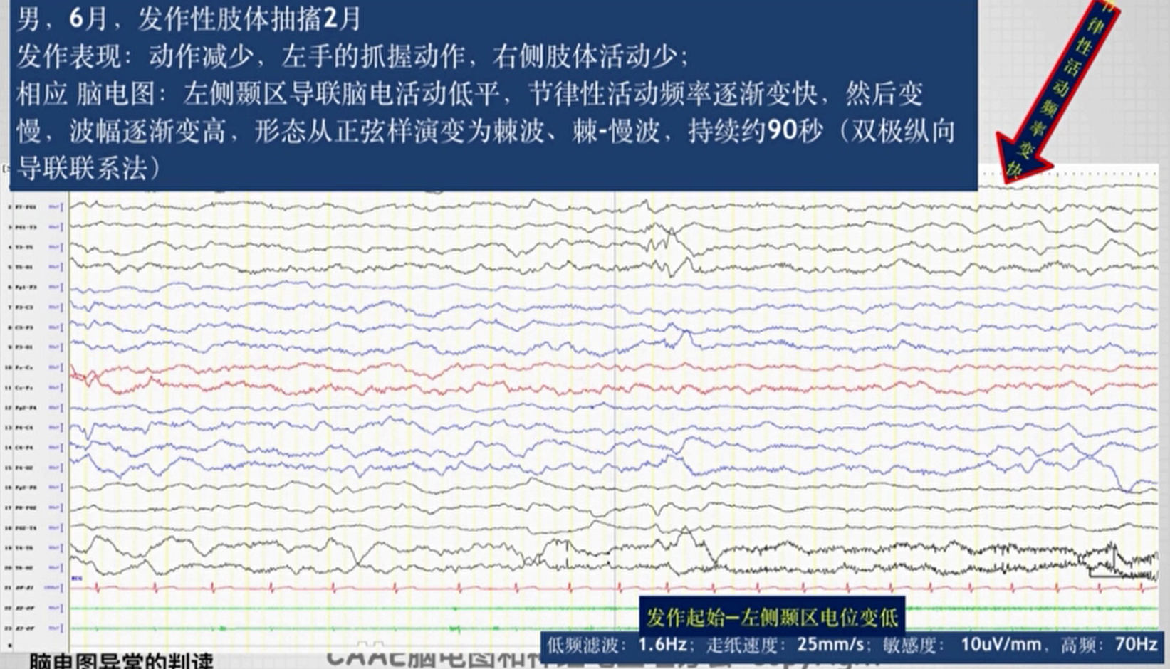 第二课:脑电图一般判读原则