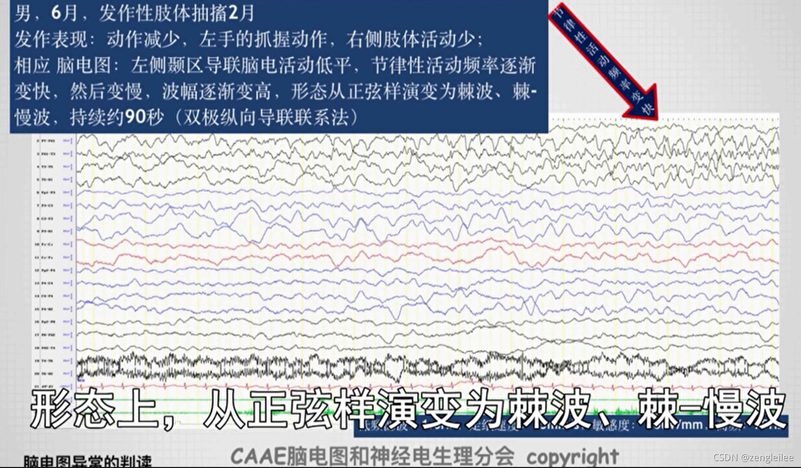 Python成神之路 第二课 脑电图一般判读原则 Python成神之路 第二课 脑电图一般判读原则