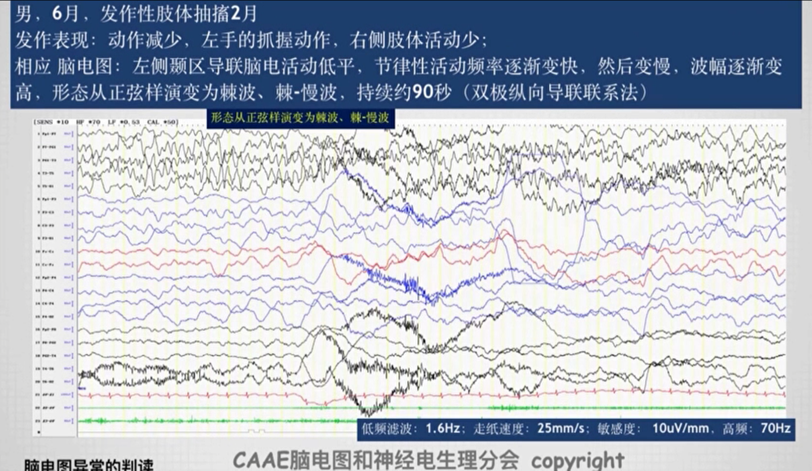 腦電圖,可見發作前瀰漫性慢波,然後在左側顳區導聯腦電活動變得低平