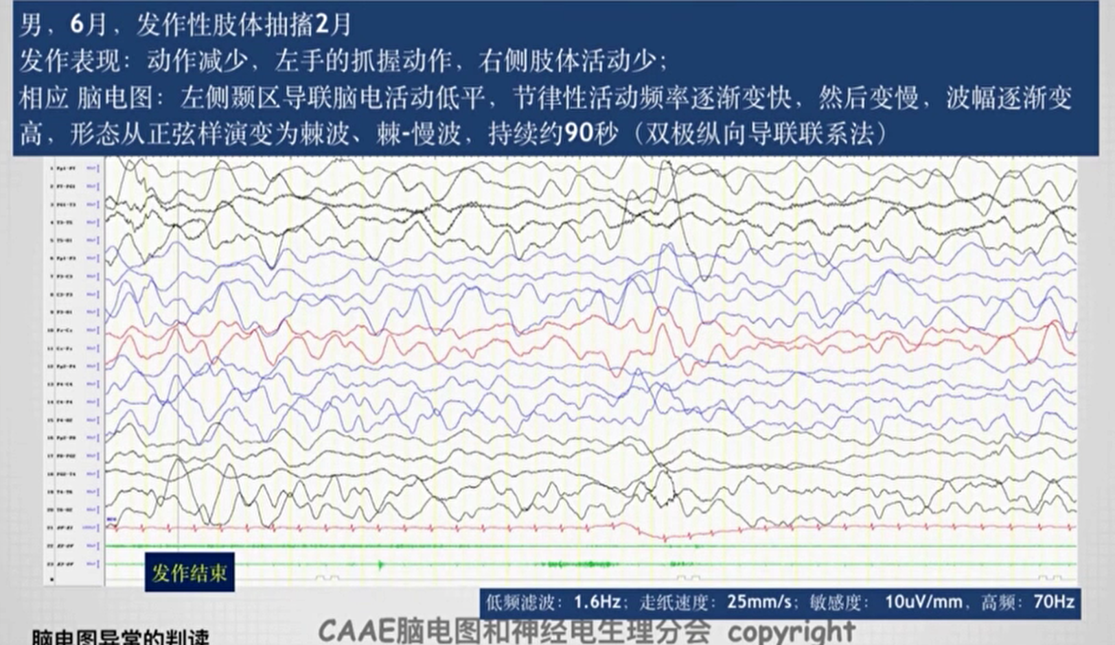 第二课 脑电图一般判读原则 Zengleilee的博客 Csdn博客 Pled脑电图