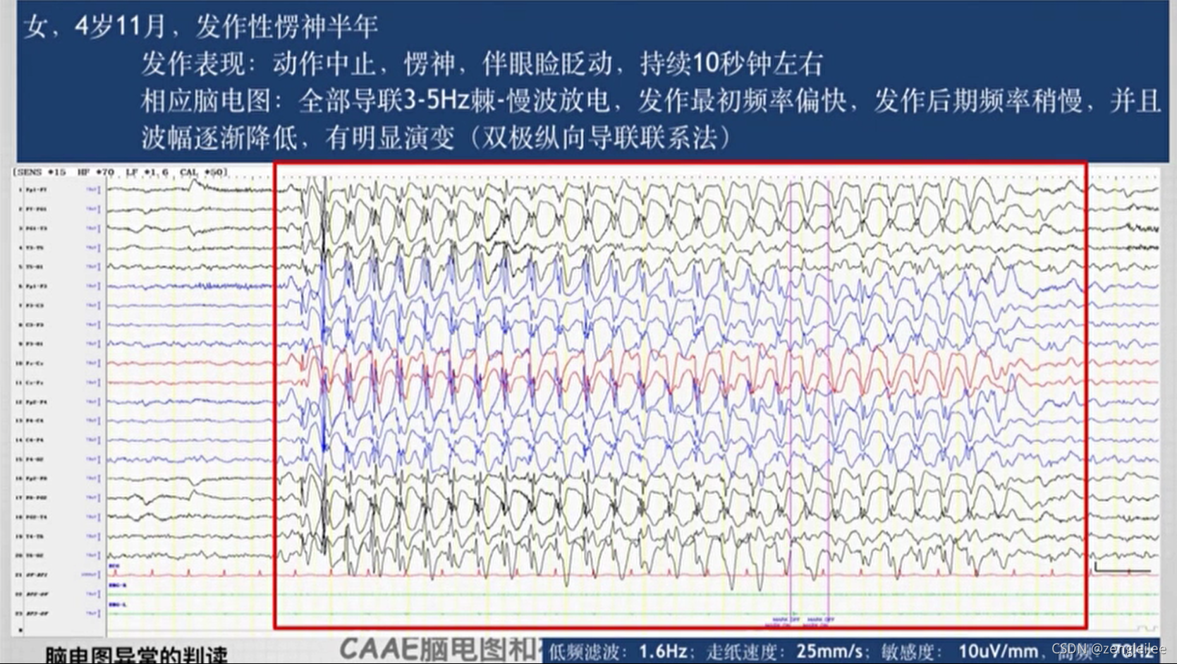 Python成神之路 第二课 脑电图一般判读原则 Python成神之路 第二课 脑电图一般判读原则