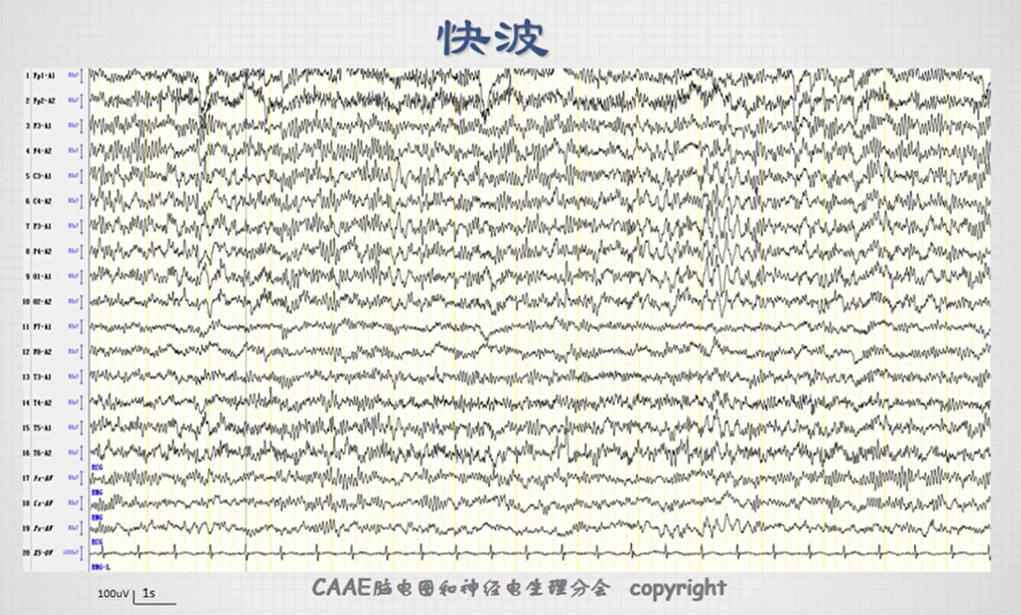 不正常脑电图波形图图片