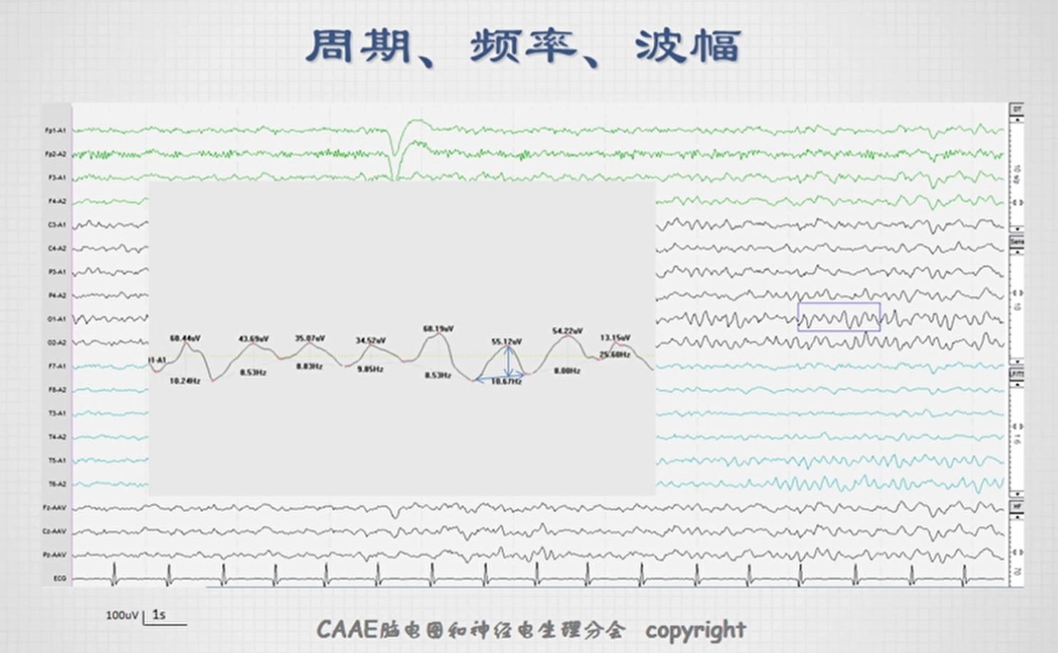 脑电图各种波形及读法图片