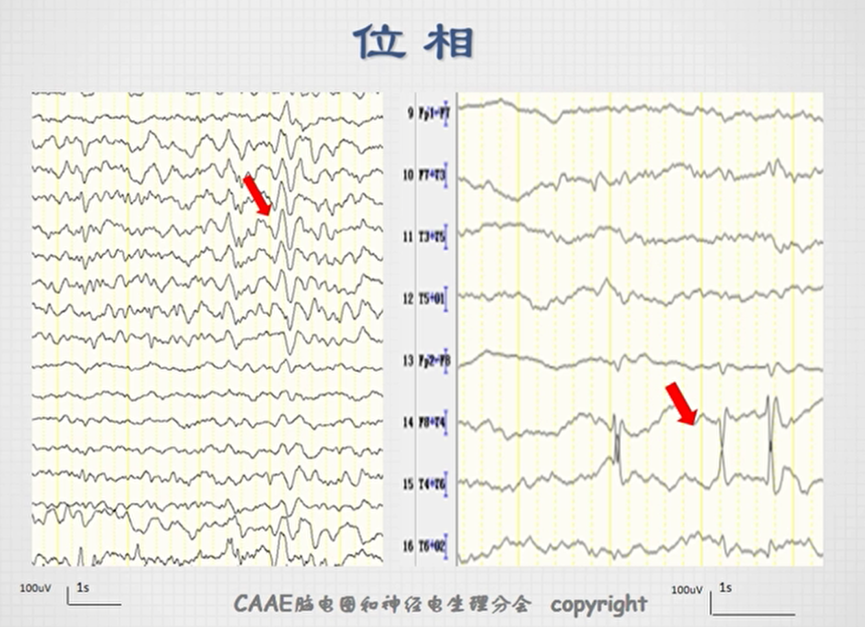 不正常脑电图波形图图片