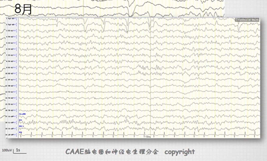 疯牛病的三相波脑电图图片