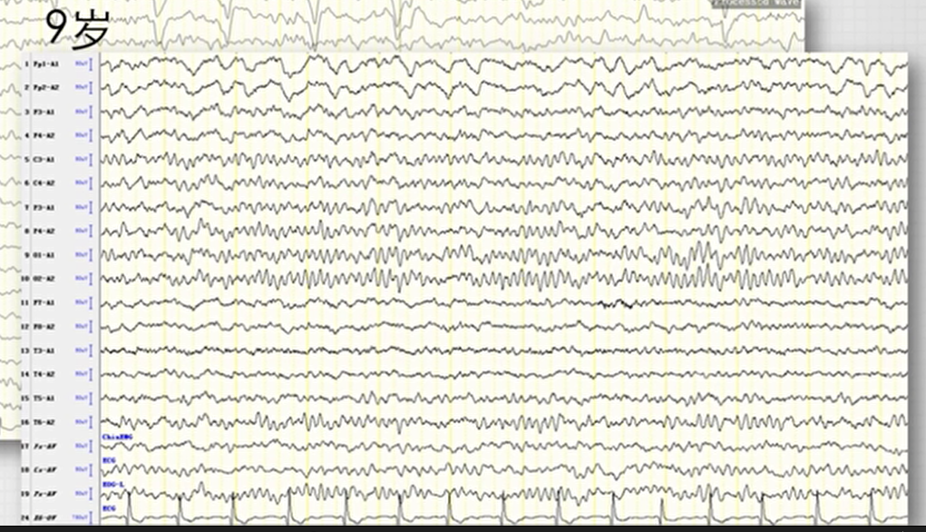 不正常脑电图波形图图片