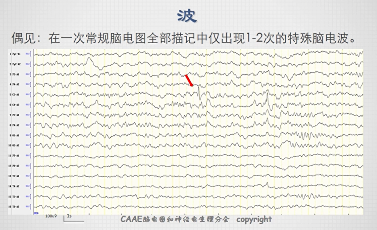 不正常脑电图波形图图片