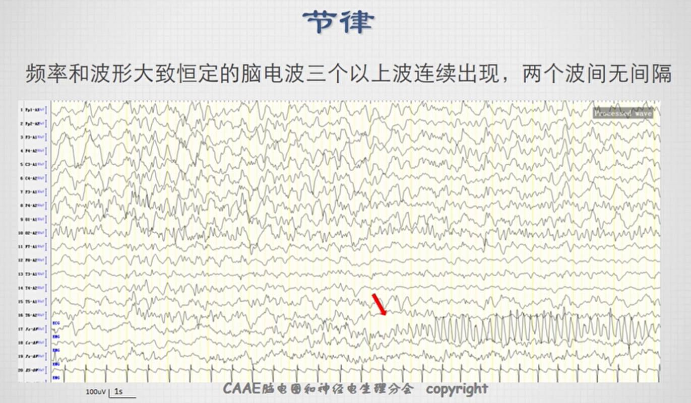 不正常脑电图波形图图片