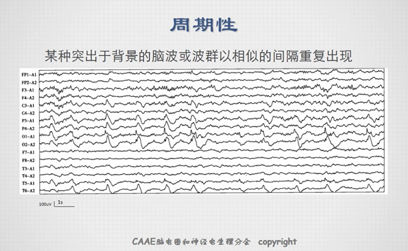 不正常脑电图波形图图片