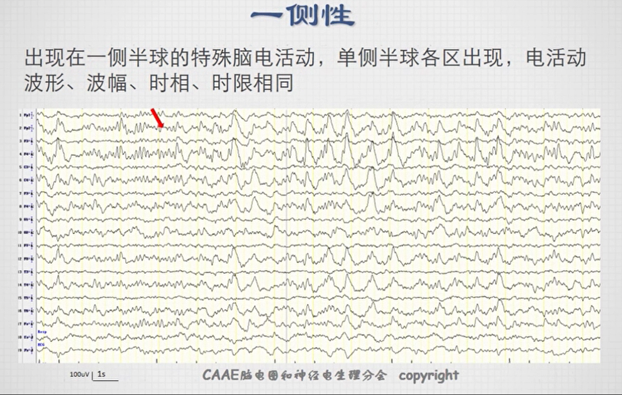 第三课:脑电图波形的分析和识别
