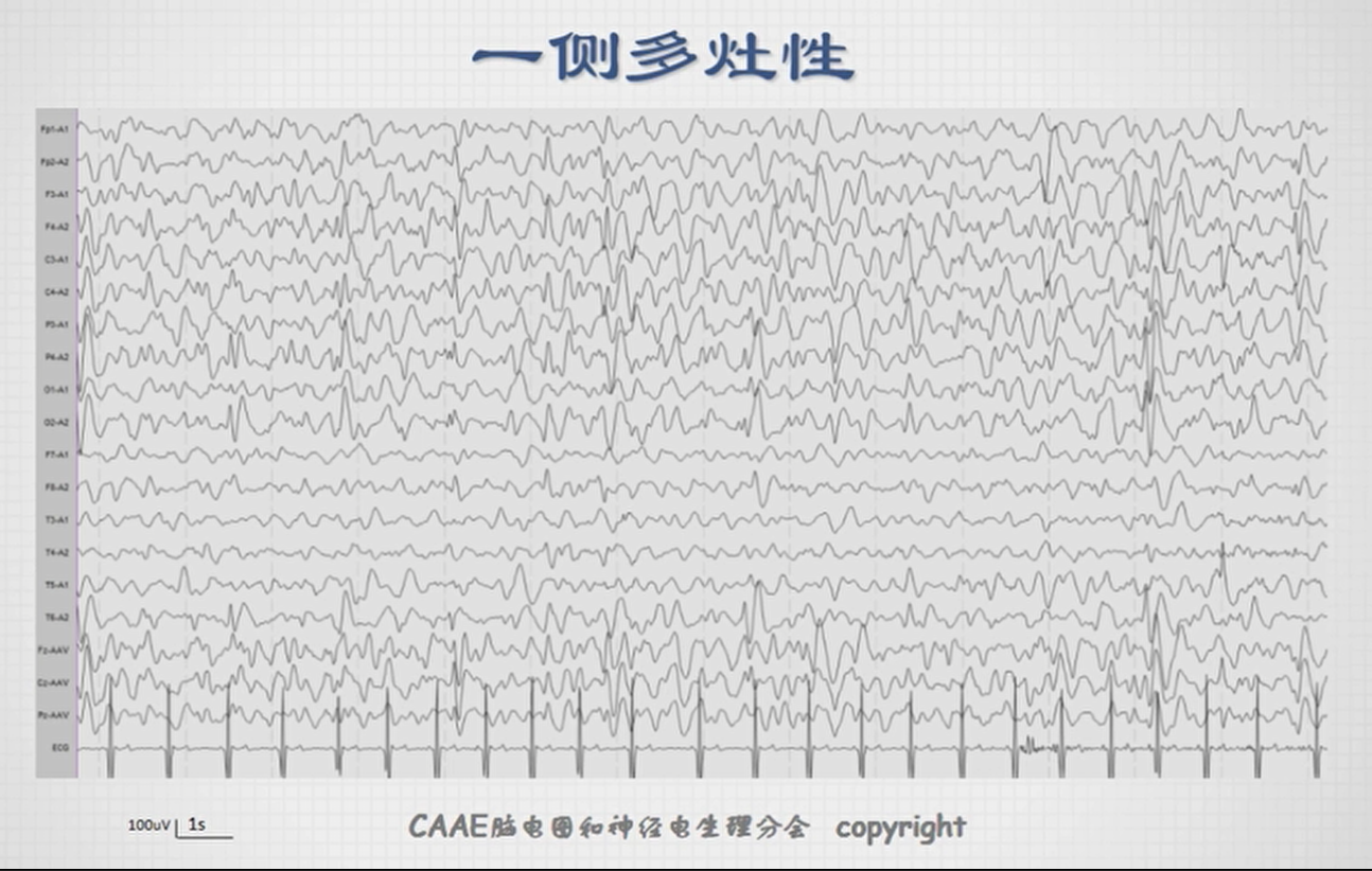脑电图各种波形及读法图片