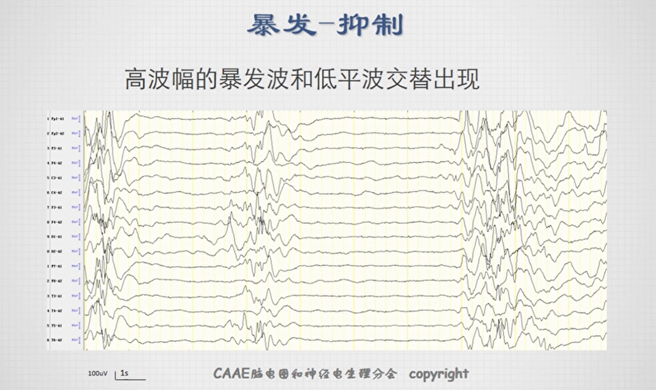 不正常脑电图波形图图片