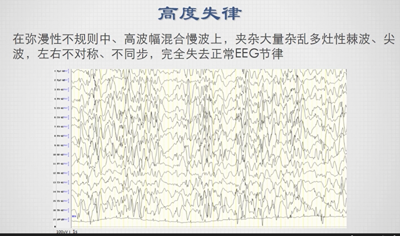 不正常脑电图波形图图片