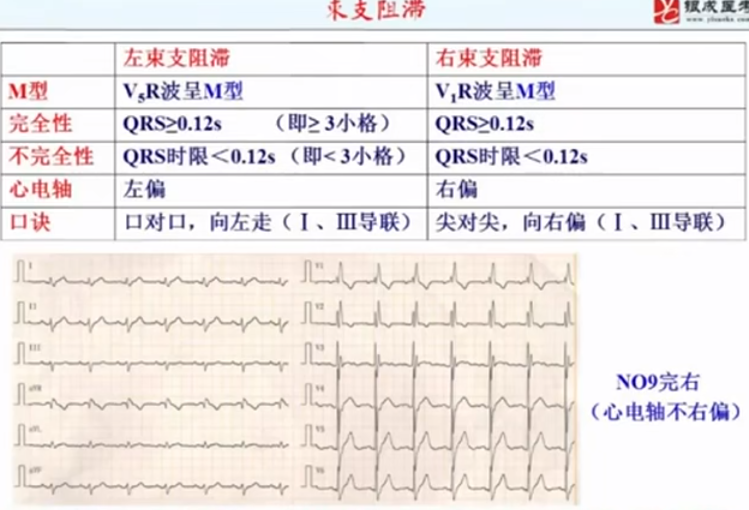 贺银成心电图总结图片