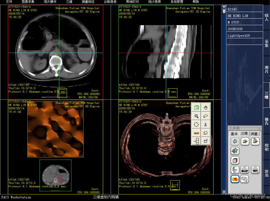 PACS三维影像后处理系统源码 PACS源码