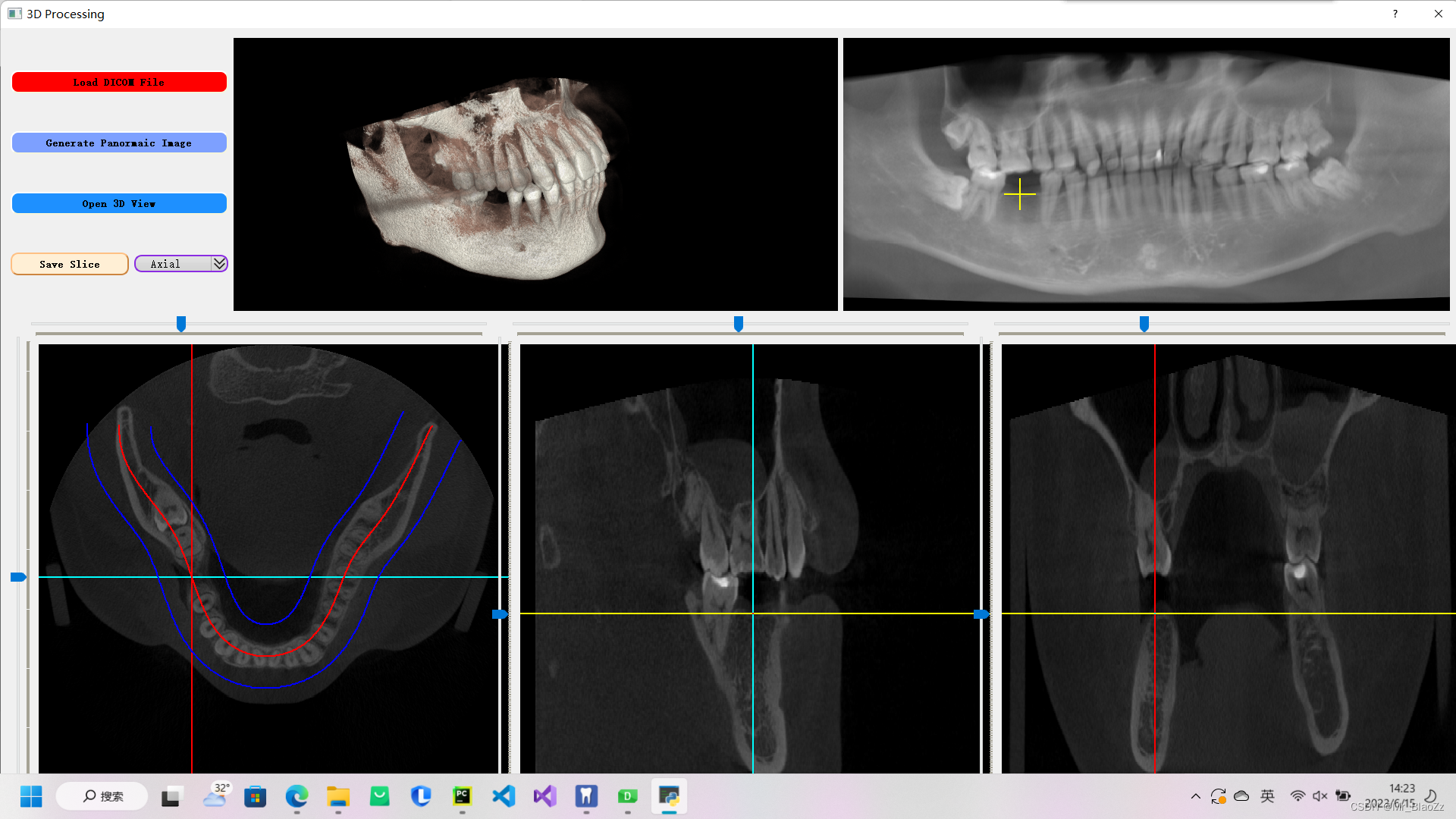 牙科医学四视图+vtk三维重建+口腔全景图像重建（pyqt5+python）