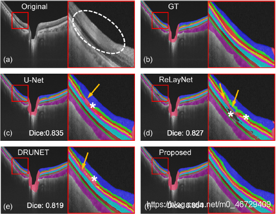 视网膜病变的视神经乳头周围OCT图像分割对比图