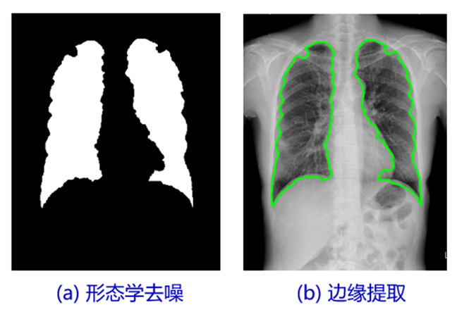 基于最小误差阈值法的特定医学图像分割算法研究-含Matlab代码