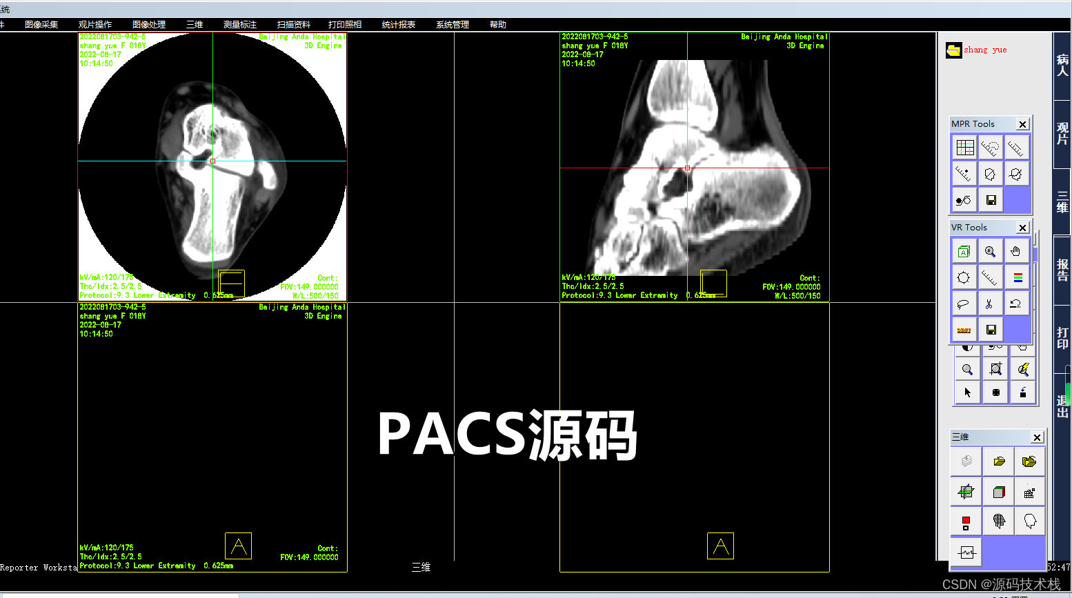 数字化医院PACS影像系统 三维影像后处理技术应用
