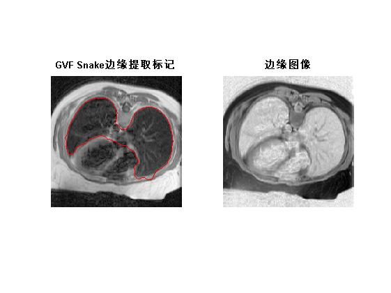 【医学图像分割】基于matlab GVF算法医学图像分割【含Matlab源码 1213期】