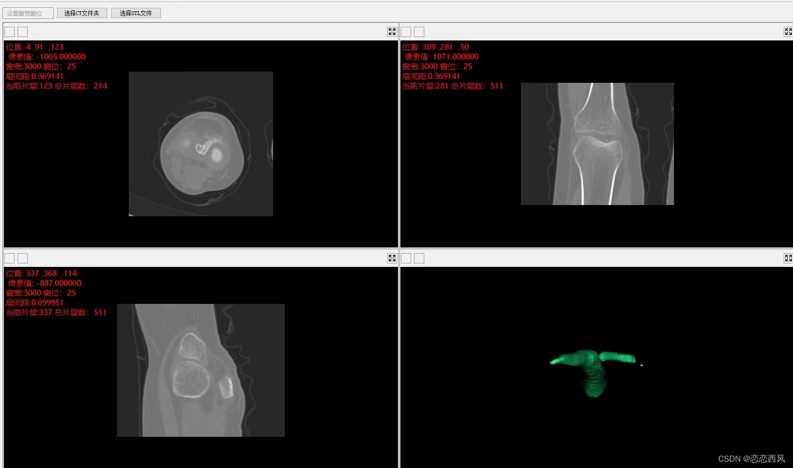 毕业设计 医学图像阅读器 DICOM CT MRI 阅读器 三维重建 可视化编程技术及应用