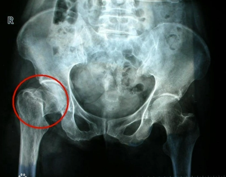 骨盆CT解剖影像图片