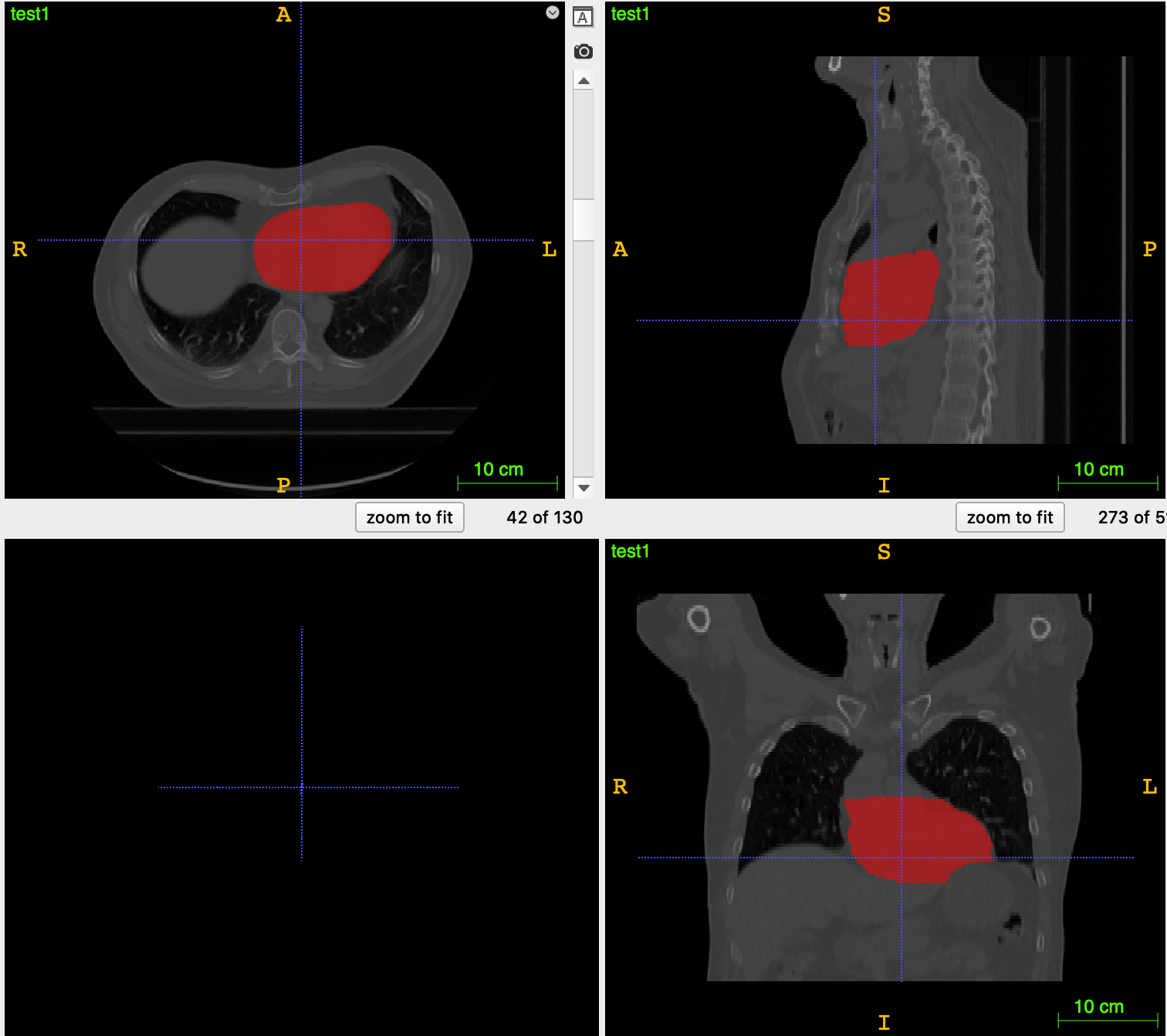 DICOM-RT struct在python中显示mask以及使用3d Slicer转换为nii_吨吨不打野的博客-CSDN博客