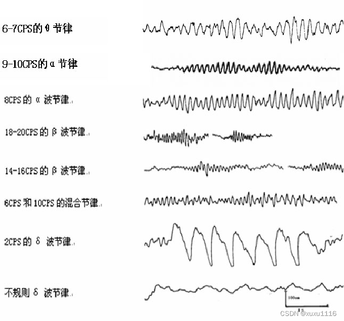 腦電圖的基本內容