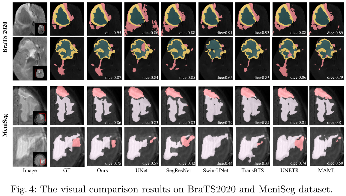 【论文笔记】NestedFormer: Nested Modality-Aware Transformer for Brain Tumor Segmentation