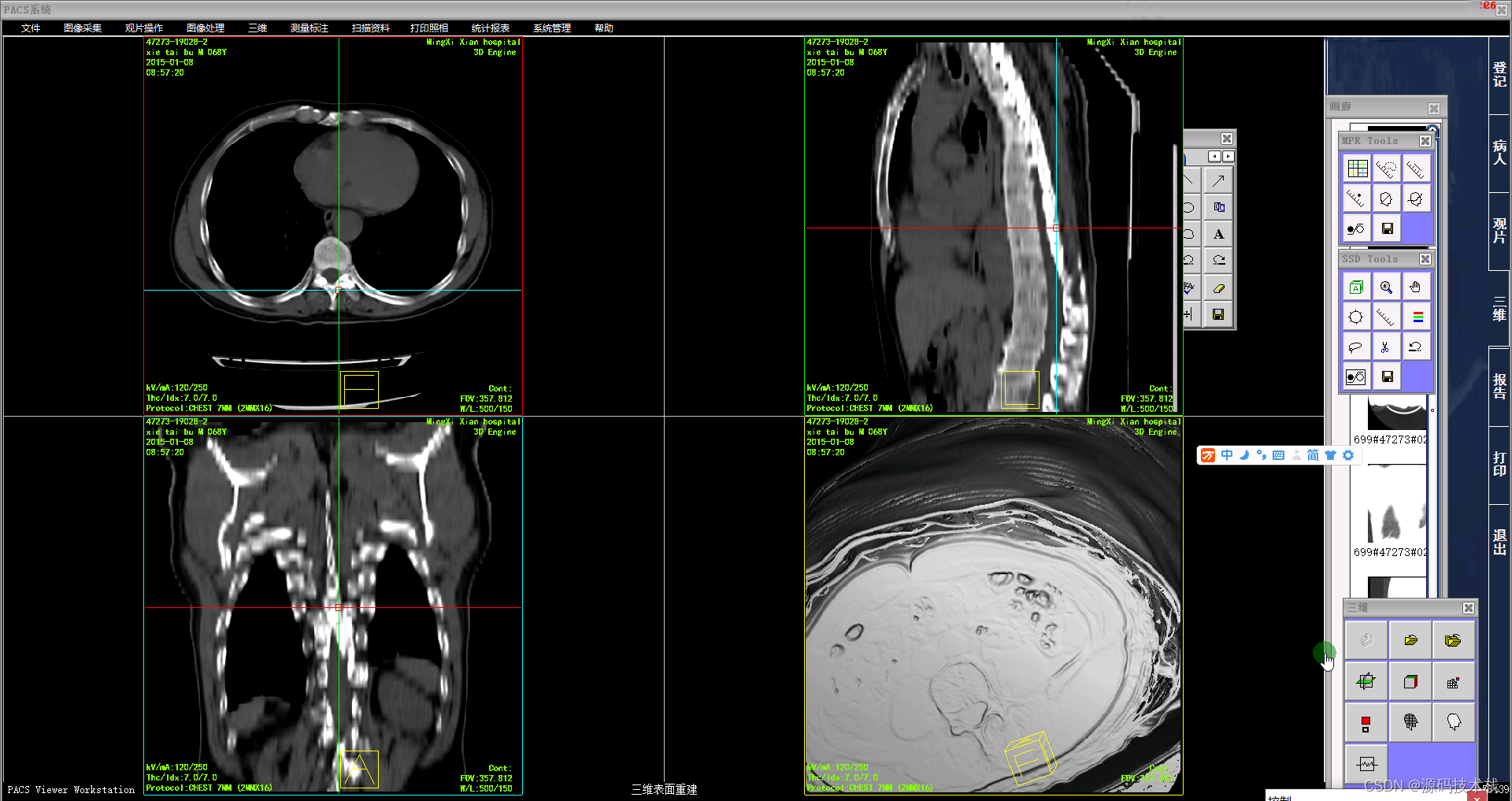 PACS系统源码，大型医院PACS源码集成三维重建