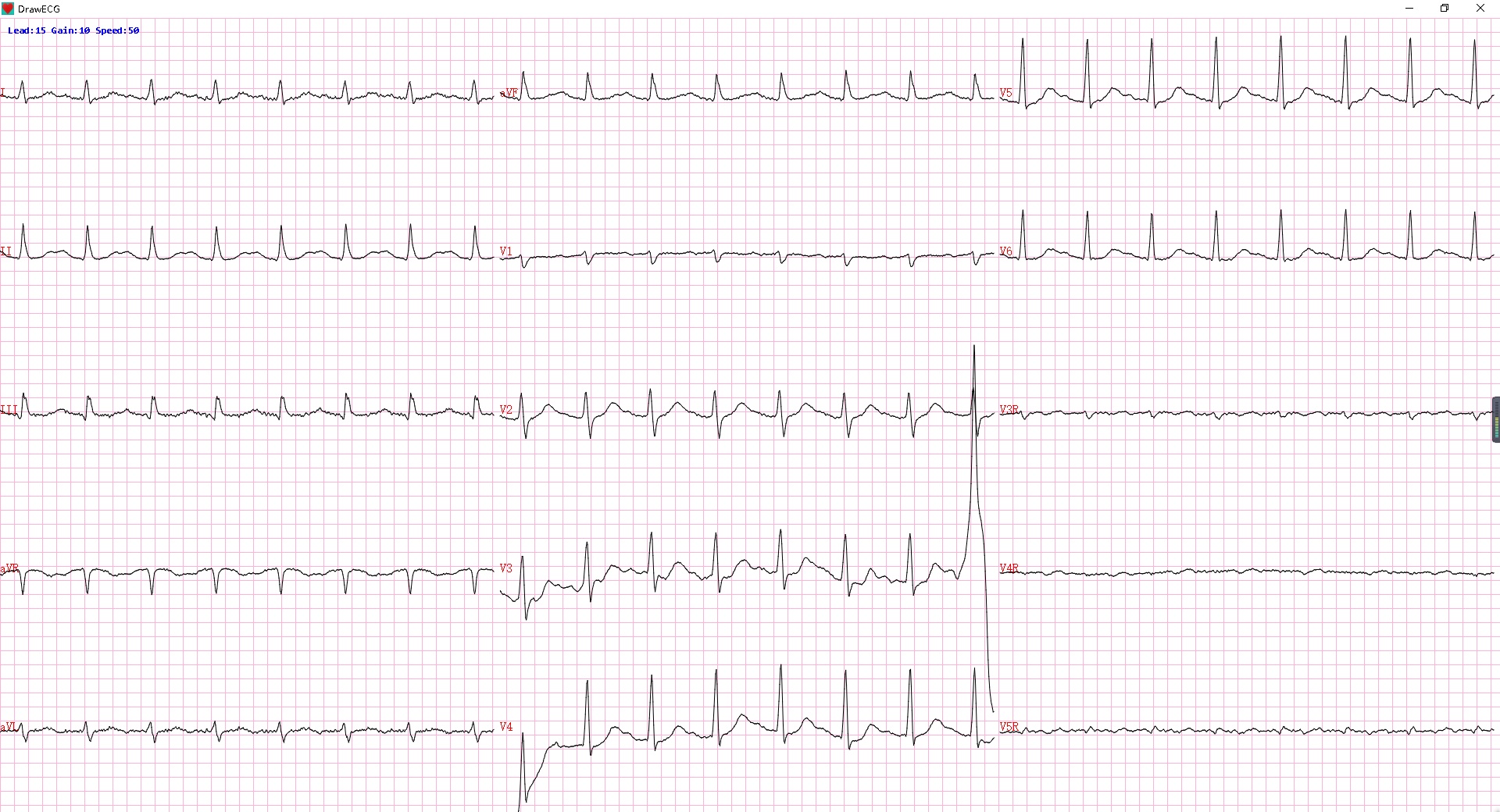 十五导联心电图解说图片