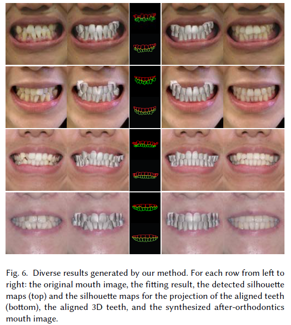 论文阅读：“iOrthoPredictor: Model-guided Deep Prediction of Teeth Alignment“