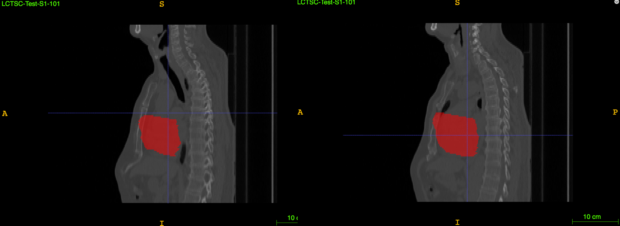 DICOM-RT struct在python中显示mask以及使用3d Slicer转换为nii_吨吨不打野的博客-CSDN博客