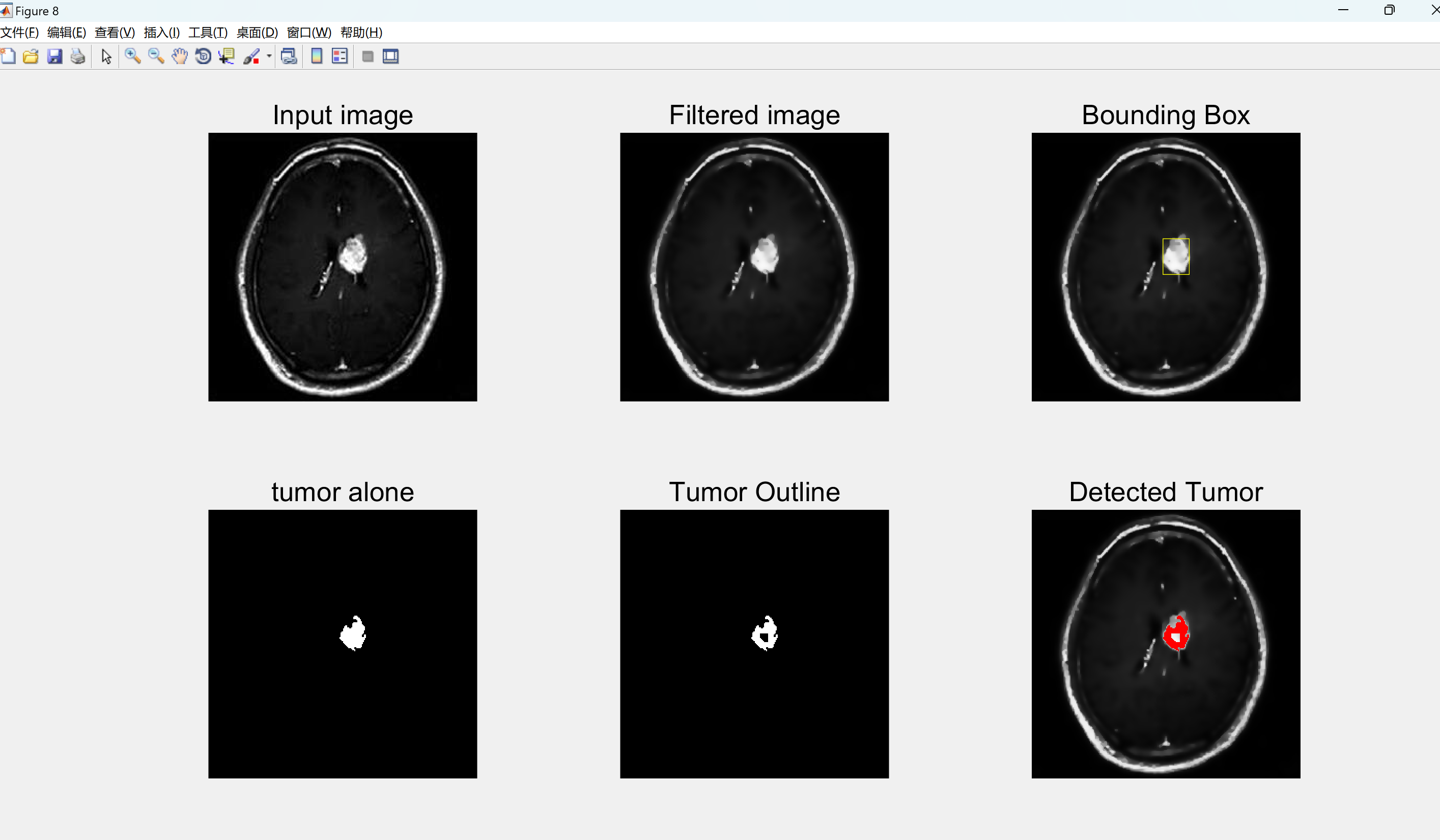 【图像处理】使用各向异性滤波器和分割图像处理从MRI图像检测脑肿瘤（Matlab代码实现）