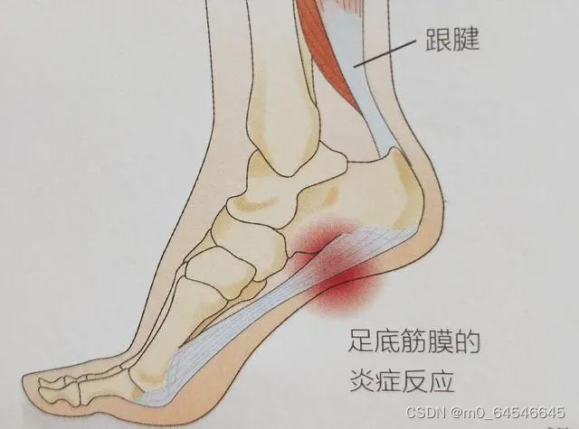 足底筋膜炎怎么治疗最有效