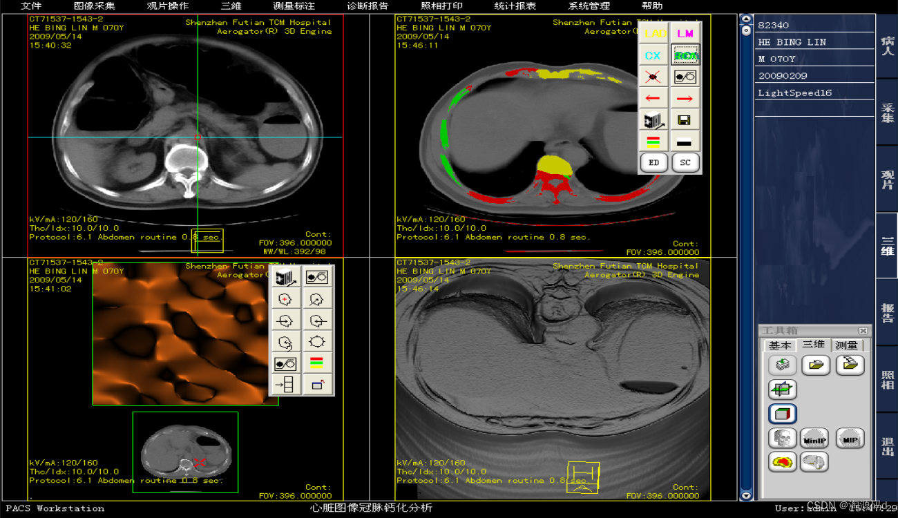 PACS三维医学影像处理系统源码