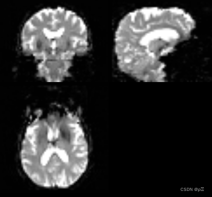 rs-fMRI的轴状位、矢状位、冠状位图片