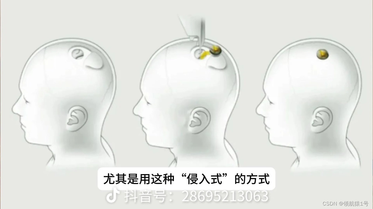 国产脑机全面超越马斯克Nearlink