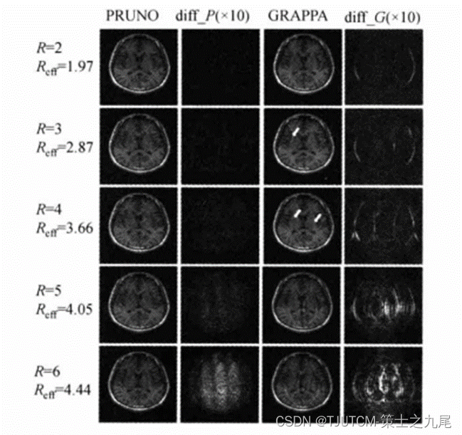 【核磁共振成像】并行采集MRI